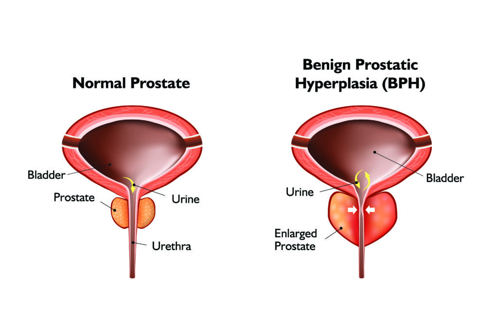 BPH prostate urolilft