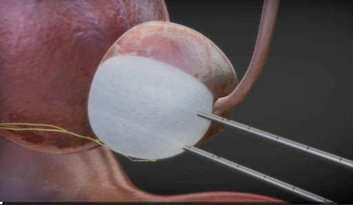 Cryoablation graphic