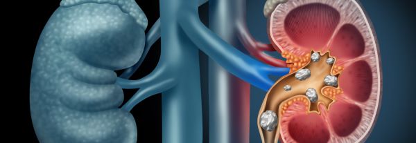 Kidney stones symptoms