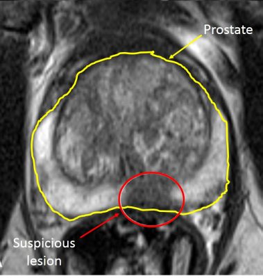 Prostate MRI