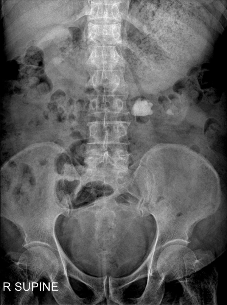 kidney stone xray