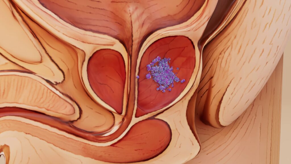 prostate cancer localized graphic