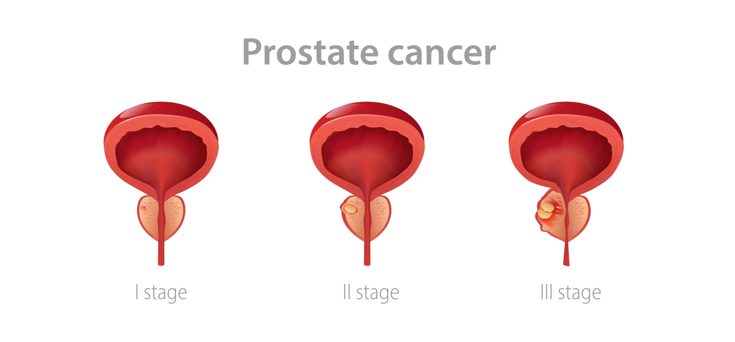 prostate cancer stages scaled